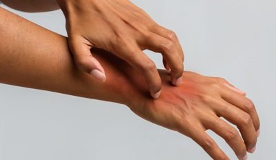The Lowdown on Psoriasis: Signs, Symptoms, and Treatments